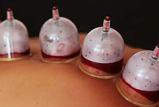 Bekam Wanita Bekam Bangi